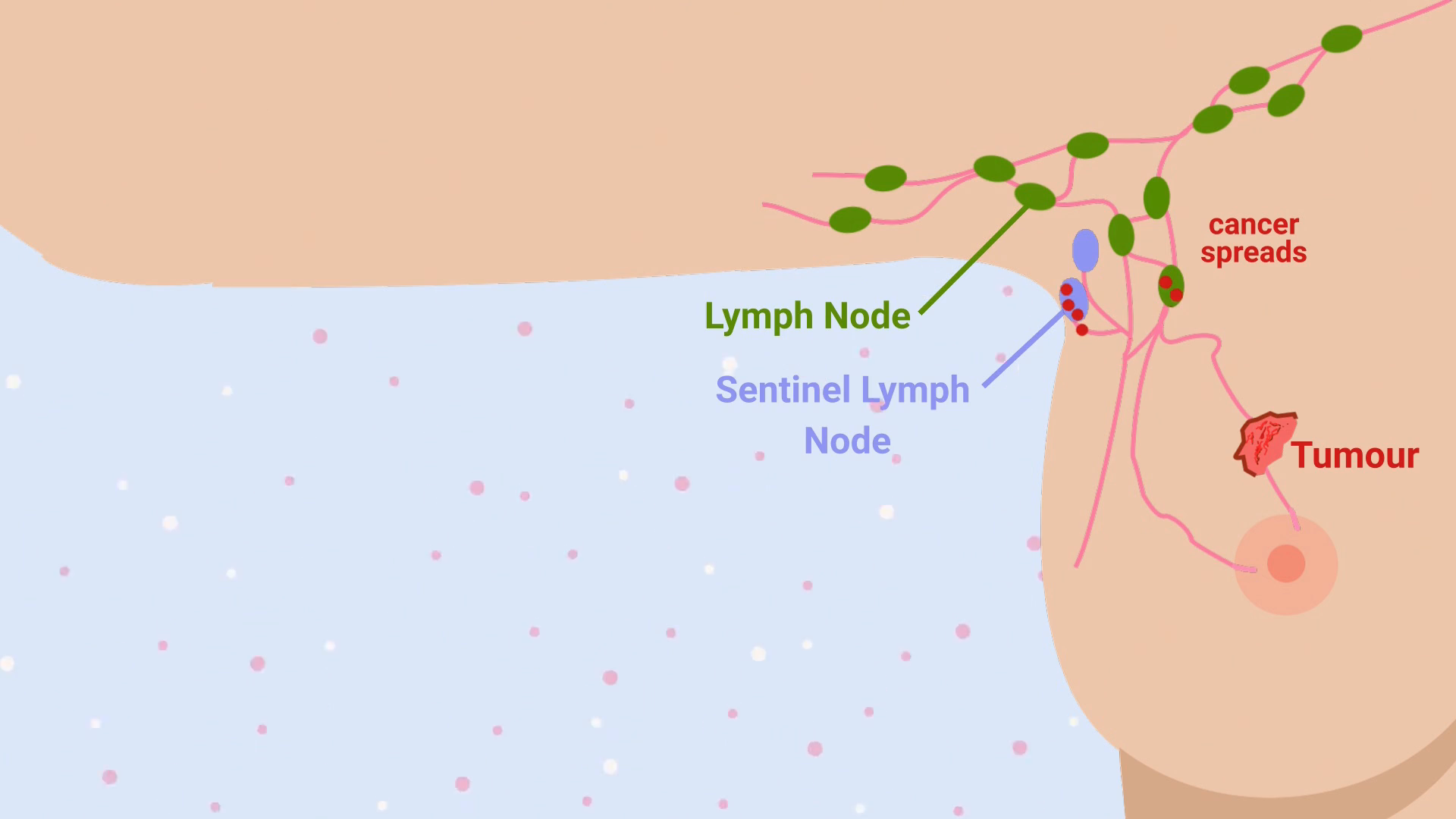 Diagram showing breast tumour, lymph nodes and how cancer can spread