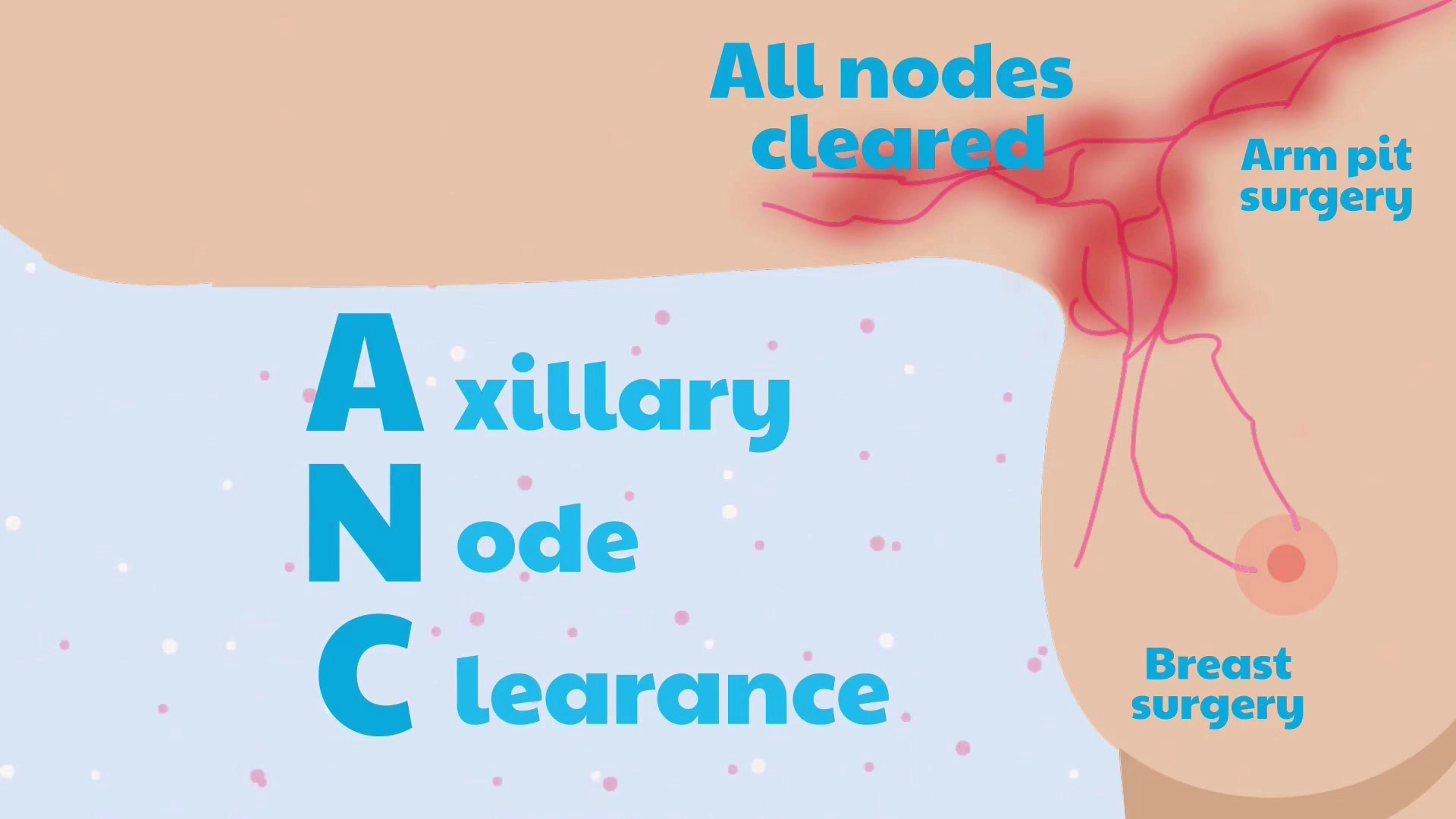 Illustration showing all armpit lymph nodes cleared